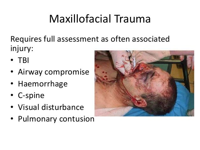 maxillo facial fractures Maxillo facial fractures